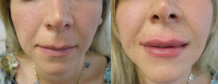 Lips Before & After Restylane